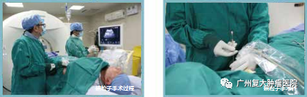 碘粒子療法：小顆粒如何對抗大腫瘤？